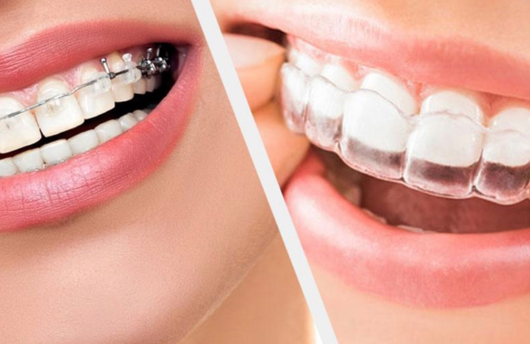 orthodontic treatments